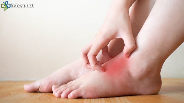 Dermatitis Pasca-Banjir: Mengapa Kebersihan Itu Sangat Penting