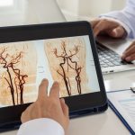 Stroke dan Bypass Otak: Menyikapi Kemajuan dalam Dunia Medis