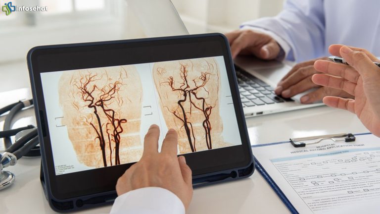 Stroke dan Bypass Otak: Menyikapi Kemajuan dalam Dunia Medis
