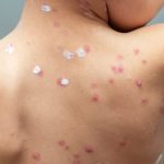 Cacar Api: Bahaya Virus Cacar Air yang Kembali Aktif Lagi
