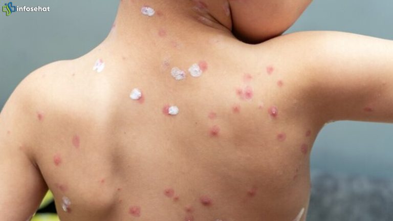 Cacar Api: Bahaya Virus Cacar Air yang Kembali Aktif Lagi
