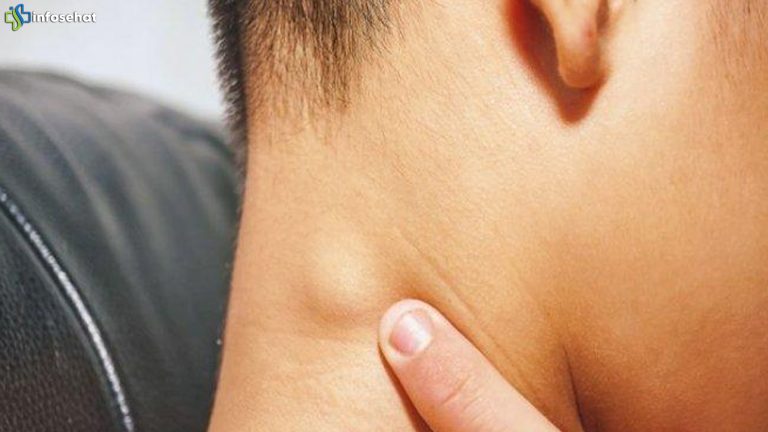 Waspada Benjolan di Leher, Mungkin Itu Tanda Kanker Limfoma