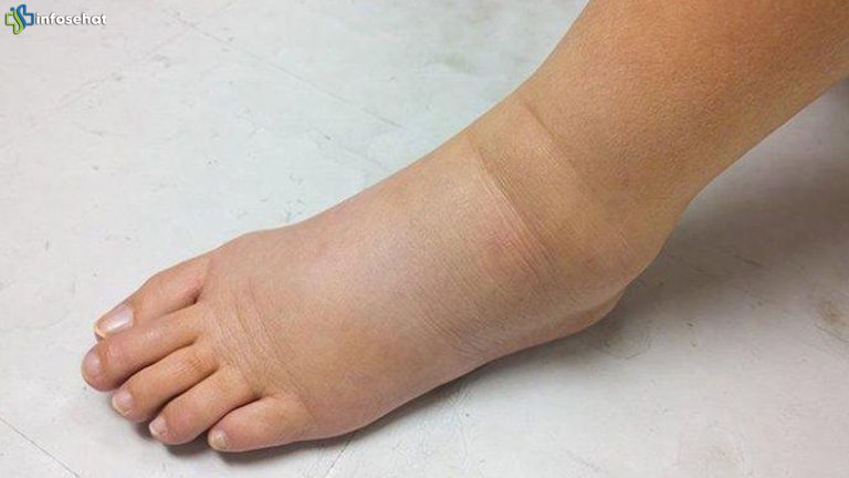 Tanda Ginjal Rusak di Kaki: Fakta yang Tak Banyak Orang Tau