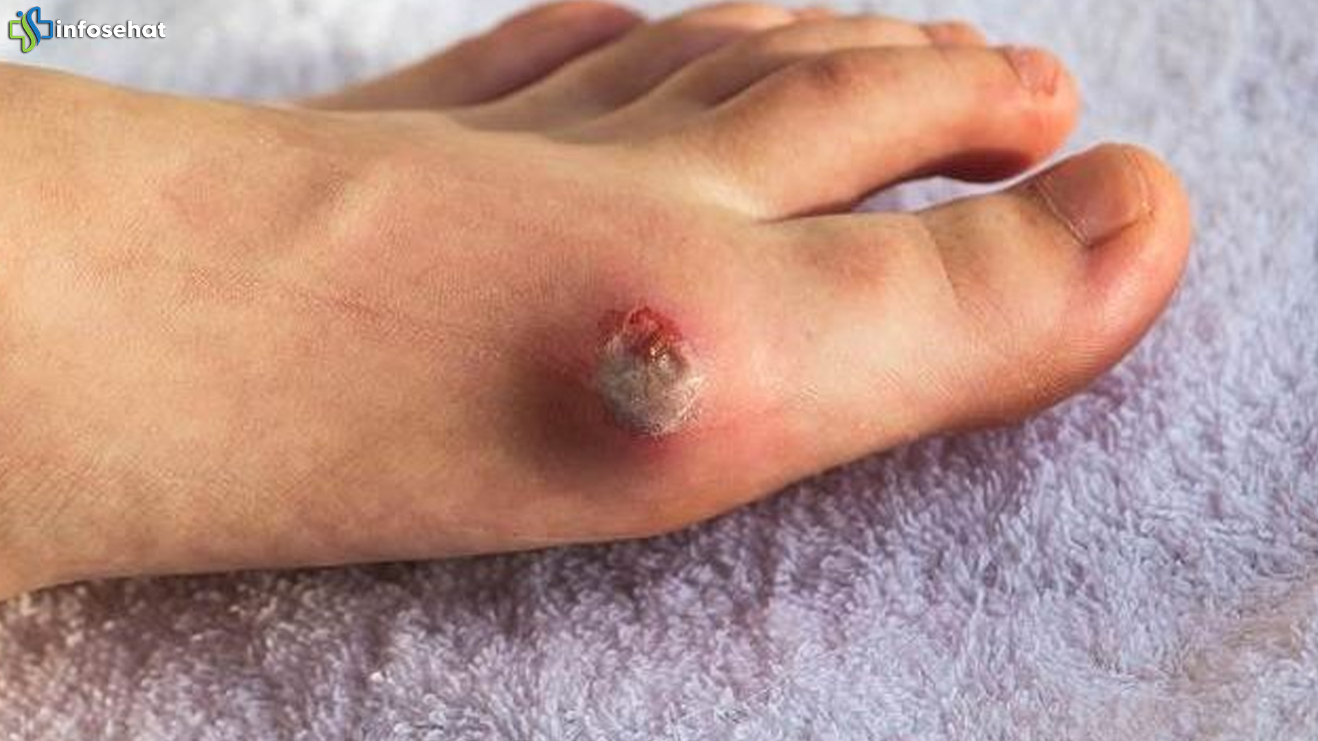 Tanda Diabetes Ringan: Ketika Luka di Tubuh Susah Hilang