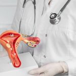 Pap Smear dan Vaksin HPV, Kunci Utama Lawan Kanker Serviks