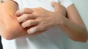 4 Masalah Kulit dengan Bercak Tak Biasa yang Berbahaya