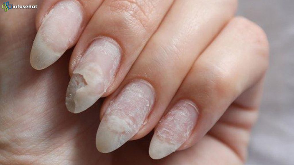 Risiko Nail Art Berlebih: Kuku Rapuh, Alergi, dan Infeksi Jamur