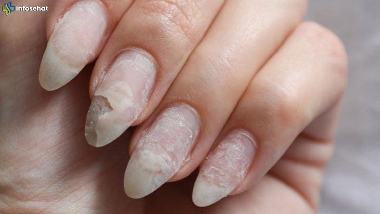Risiko Nail Art Berlebih: Kuku Rapuh, Alergi, dan Infeksi Jamur