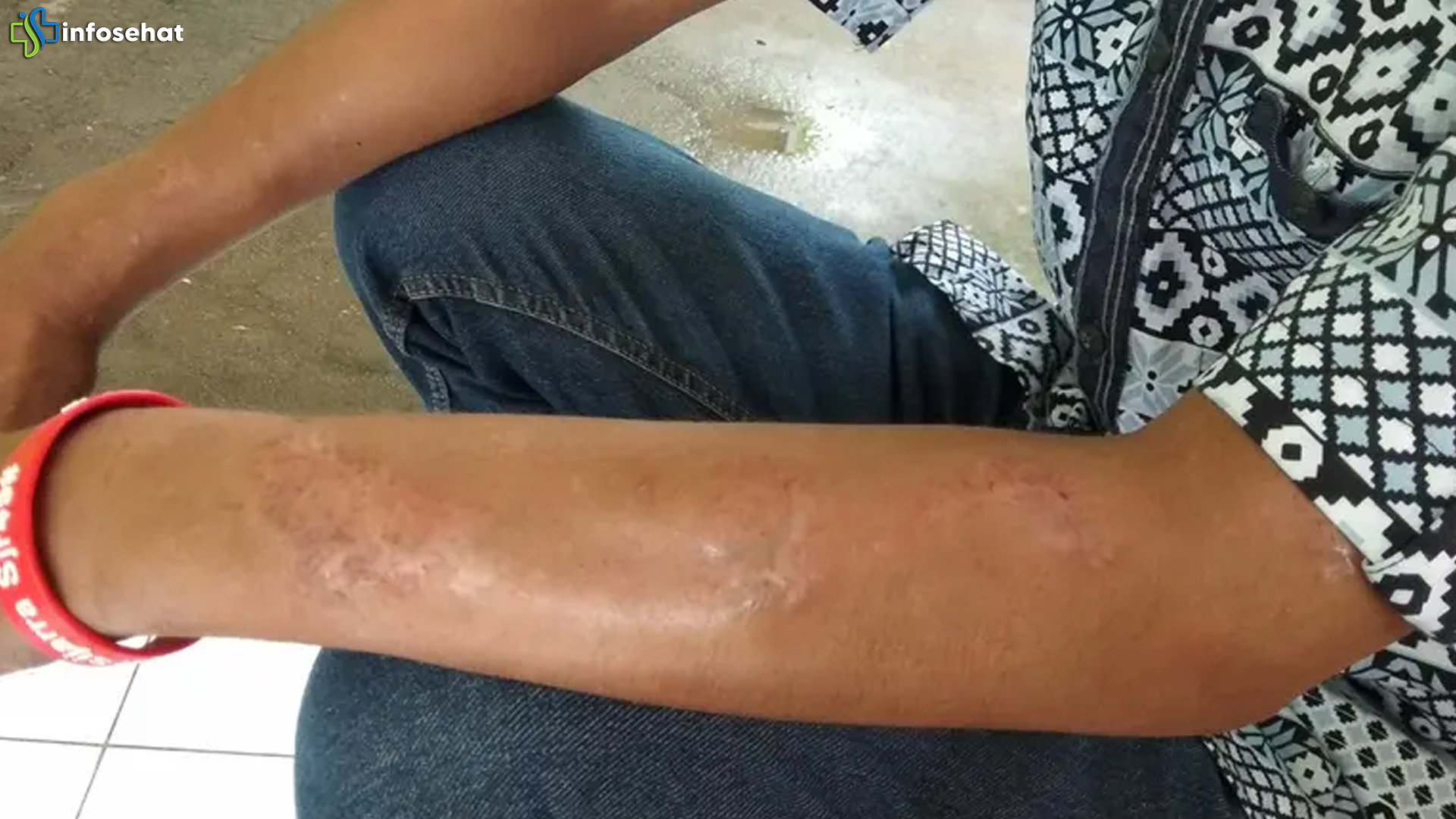 Realita Kasus Kusta di Indonesia yang Masuk 3 Besar Dunia