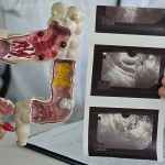 Gen Z Waspada, 4 Tanda Kanker Usus Besar yang Sering Terjadi