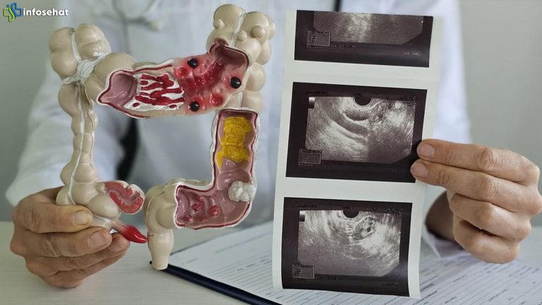 Gen Z Waspada, 4 Tanda Kanker Usus Besar yang Sering Terjadi