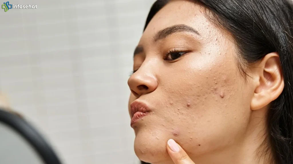 Kolesterol Naik? Jangan Anggap Remeh 2 Tanda di Wajah Ini