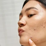 Kolesterol Naik? Jangan Anggap Remeh 2 Tanda di Wajah Ini