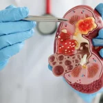 Gagal Ginjal Kronis Meningkat, 5 Fakta Penting yang Harus Lo Tau