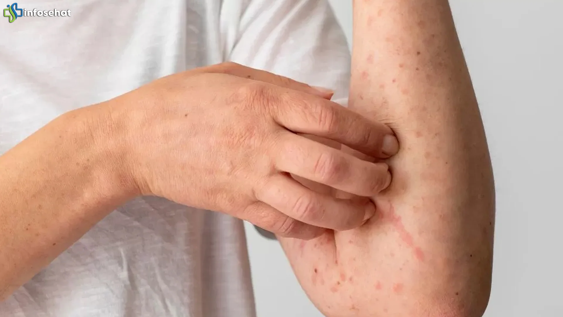 Ruam Kulit Misterius: 5 Gejala Ini Ungkap Penyakit Ginjal Stadium 3 Dini