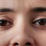 5 Cara Efektif Mengatasi Ptosis Agar Mata Tampak Segar Kembali