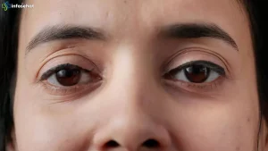 5 Cara Efektif Mengatasi Ptosis Agar Mata Tampak Segar Kembali