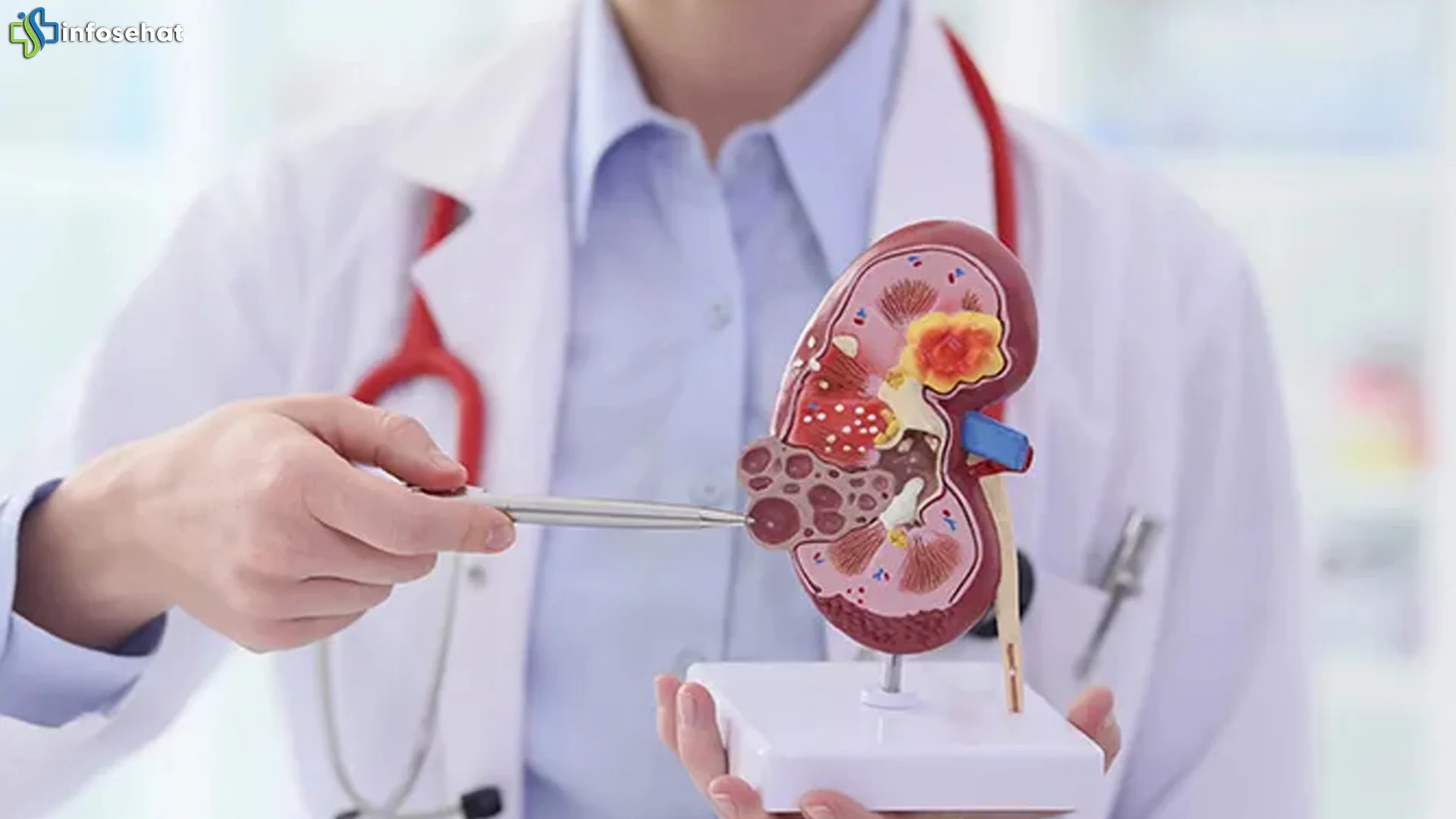 5 Penyebab Batu Ginjal yang Jarang Diketahui dan Perlu Diwaspadai