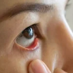 5 Tips Mengatasi Mata Kering dan Air Mata yang Cepat Menguap