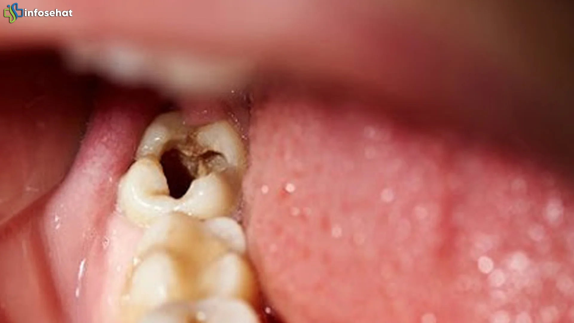 Gigi Berlubang 2026 Bisa Memicu Risiko Serangan Jantung