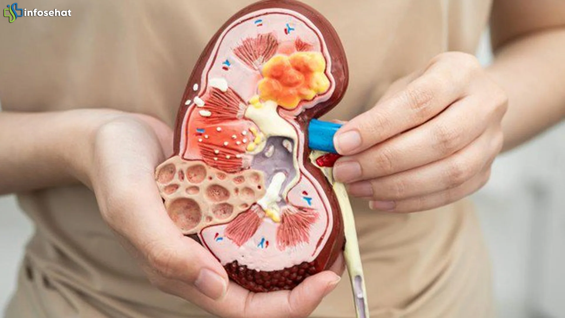 5 Situasi Batu Ginjal Yang Membutuhkan Penanganan Medis Cepat