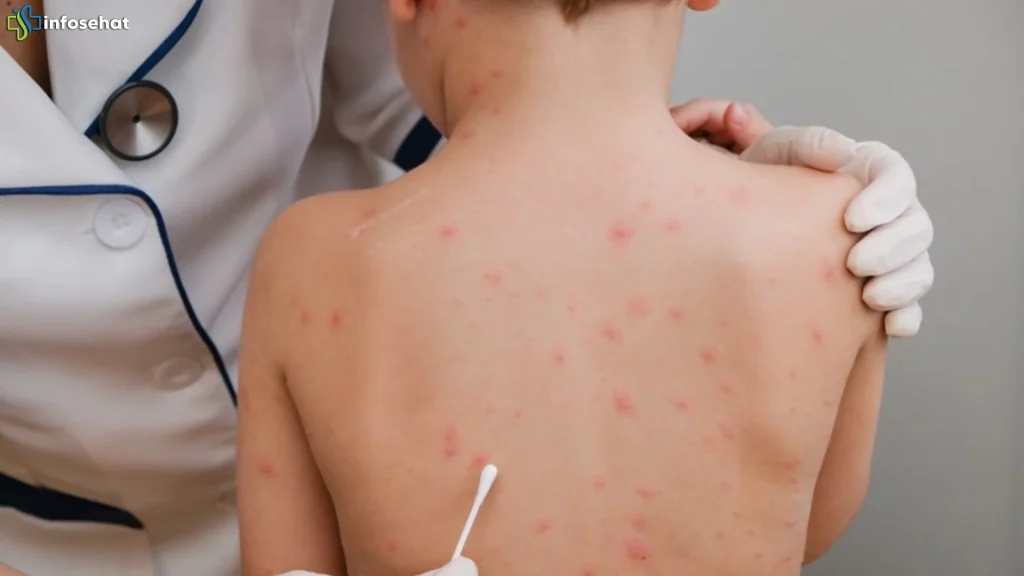 Kenali 5 Tanda Campak Pada Anak Agar Penanganan Bisa Lebih Cepat