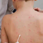 Kenali 5 Tanda Campak Pada Anak Agar Penanganan Bisa Lebih Cepat