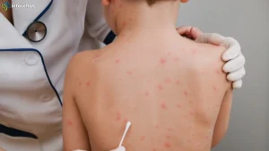 Kenali 5 Tanda Campak Pada Anak Agar Penanganan Bisa Lebih Cepat