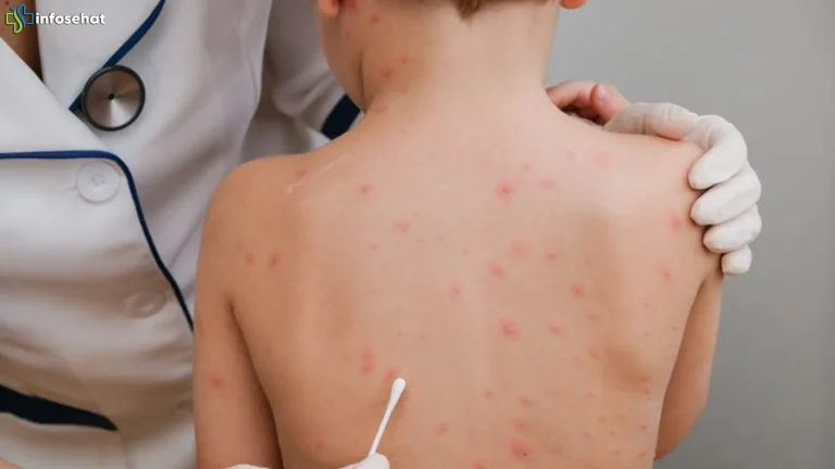 Kenali 5 Tanda Campak Pada Anak Agar Penanganan Bisa Lebih Cepat