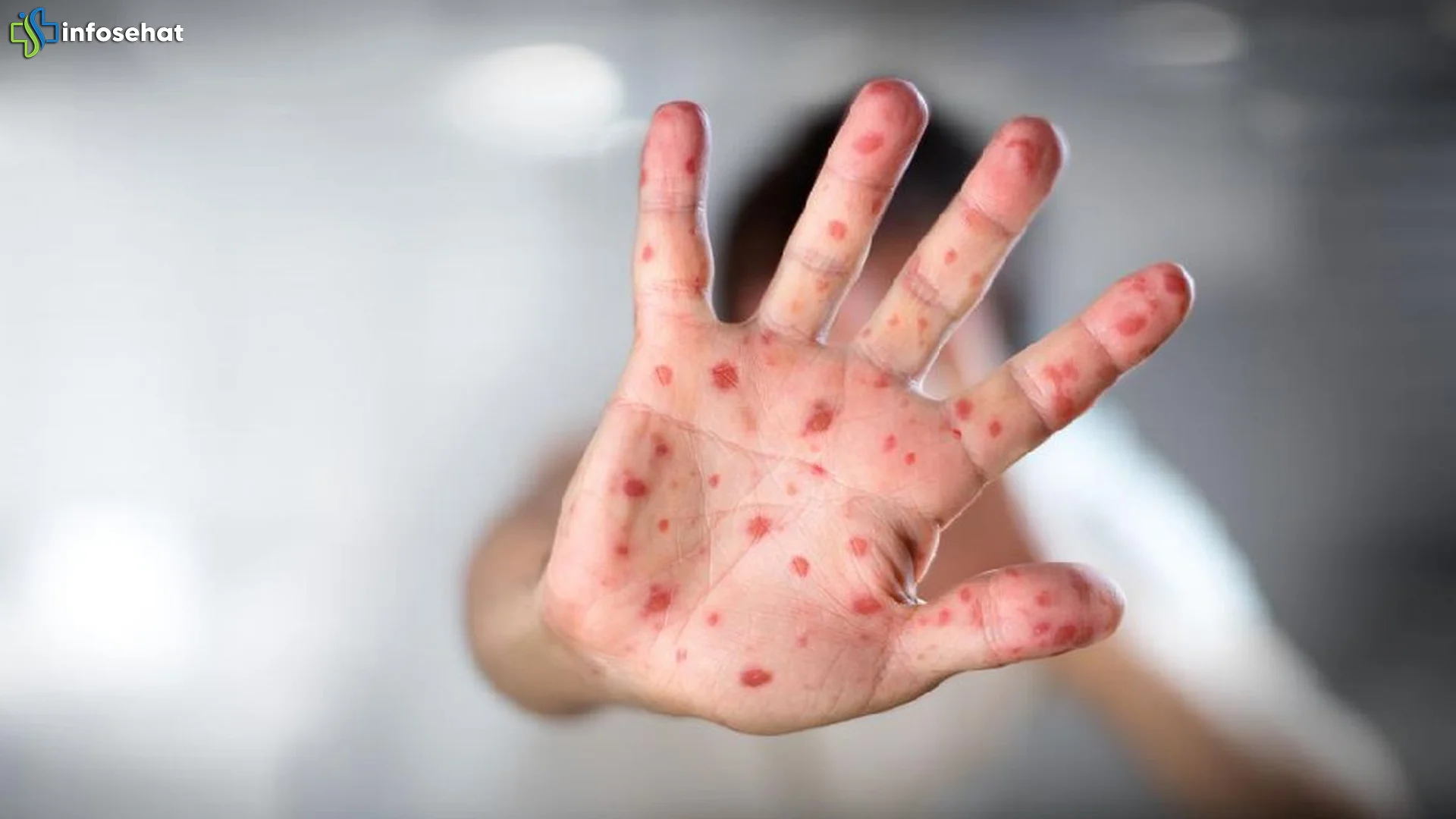 Fakta 5 Terbaru Dokter Jelaskan Perbedaan Ruam Campak Dan Cacar Air