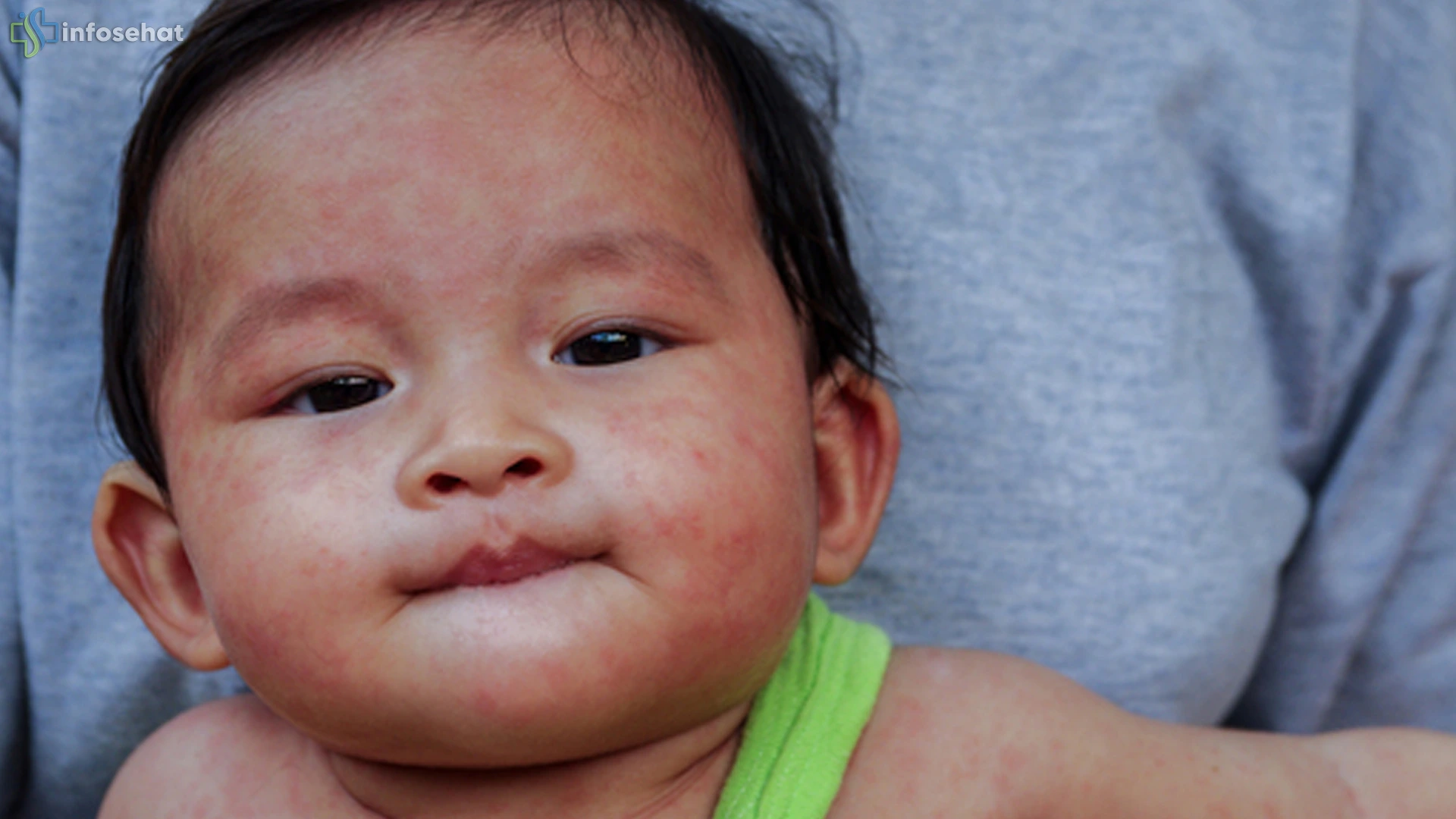 4 Tanda Mata Sensitif Cahaya Saat Campak yang Perlu Diketahui