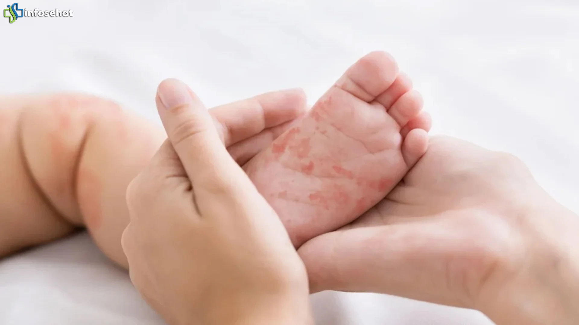 Kenali 5 Tanda Campak Pada Anak Agar Penanganan Bisa Lebih Cepat