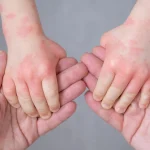 Fakta 5 Terbaru Dokter Jelaskan Perbedaan Ruam Campak Dan Cacar Air