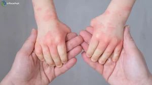 Fakta 5 Terbaru Dokter Jelaskan Perbedaan Ruam Campak Dan Cacar Air