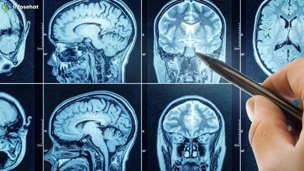 Gejala Kesemutan Ternyata 10 Tumor di Otak Wanita Baru Terungkap